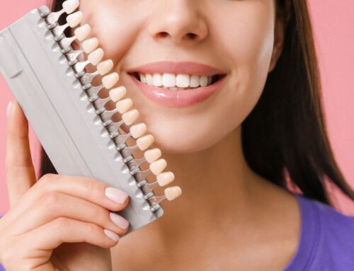 Everything You Need To Know About Veneers