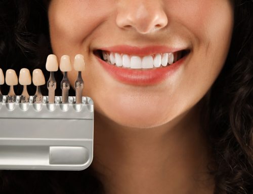 Why Professional Teeth Whitening Gets Better Results Than Store-Bought Kits